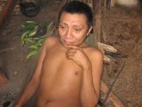 Dieser Yanomami ist durch die Onkozerkose (Flussblindheit) erblindet.